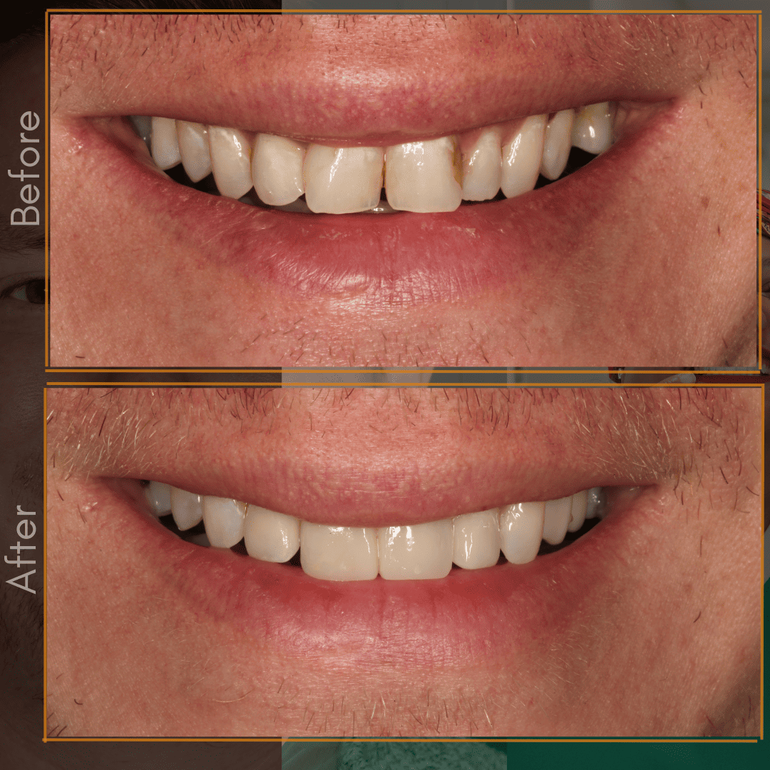 Porcelain-Bridge-1-1