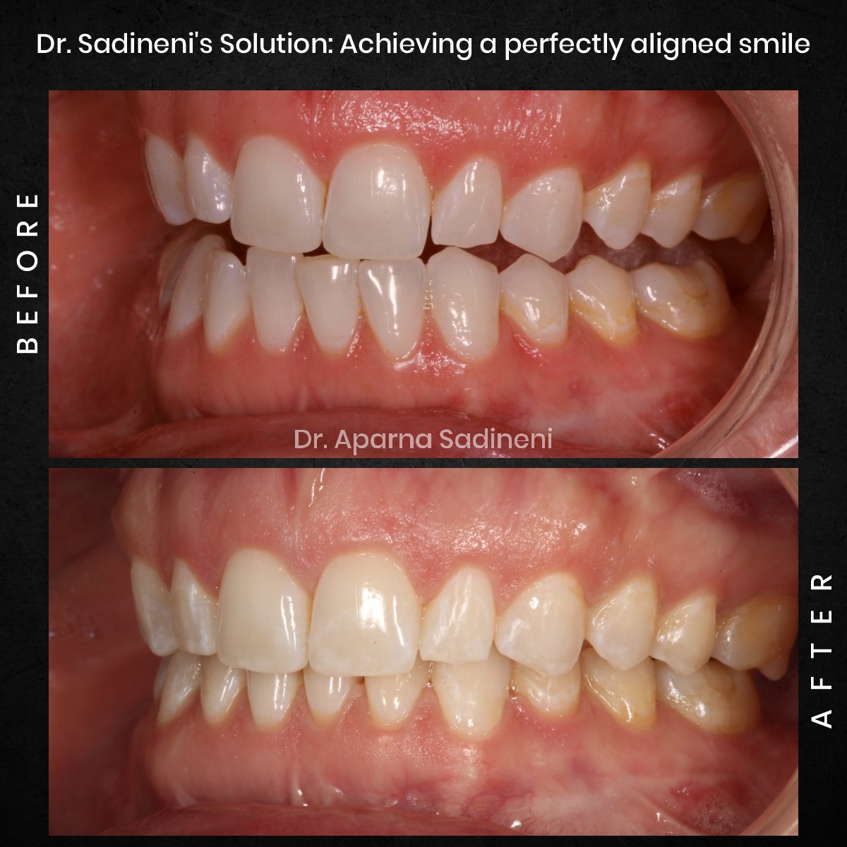 DMD-DEC-GRID-1-POST-1-TEETH-BA-ALICIA_3-1