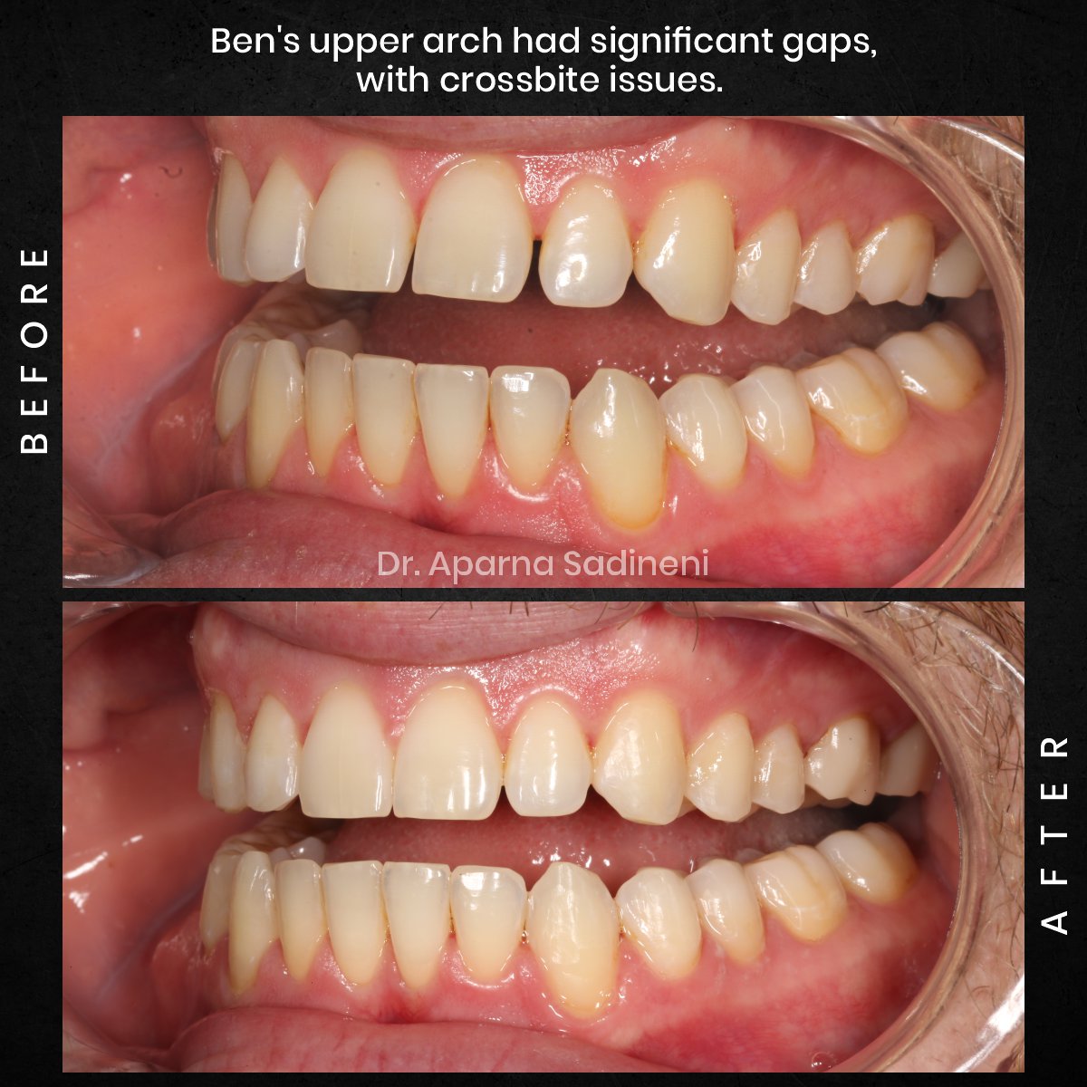 DMD-OCT-GRID-2-POST-3-TEETH-BA-BEN-C_1
