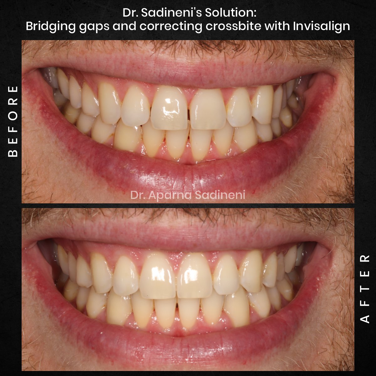 DMD-OCT-GRID-2-POST-3-TEETH-BA-BEN-C_4