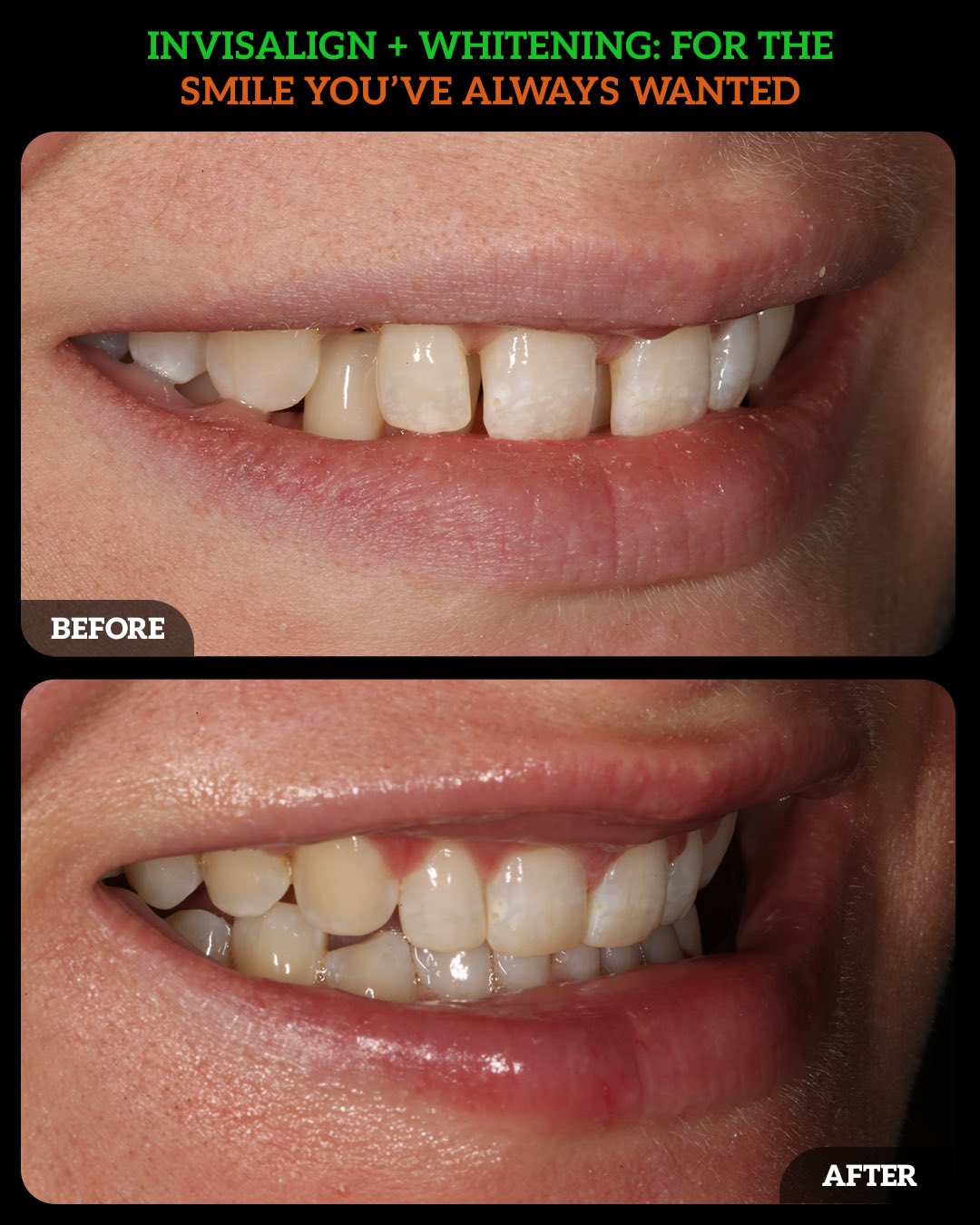 invisalign dublin 1